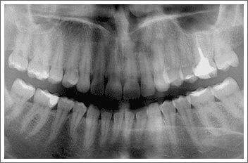 rentgen zębów