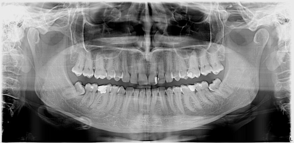 pantomogram panorama zębów