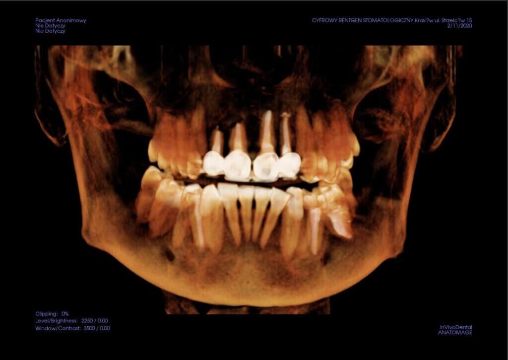 tomografia zębów CBCT 3D